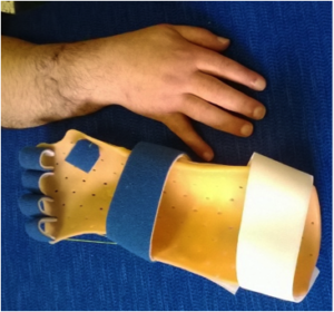 splint dinamico pro estensione MMFF in esito reimpianto