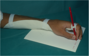 splint con penna inclusa per consentire la scrittura in esito di lesione complessa all'avambraccio